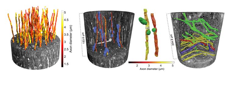 The picture: On left: Large axons of varying diameter (see colour bar) within an x-ray nano-holotomography volume of the white matter from a brain. Second from left: the paths of the axons are affected by the positions of cell clusters (in blue). Third from left: vacuoles (green) could also be found in the tissue and affected the diameter of axons. Right: Large crossing axons, travelling in different directions (represented by the green/yellow colours), in another region of the white matter. The large field-of-view accessible via the synchrotron imaging experiments allows for the tracking of two axons that twist around each other (in red and blue).