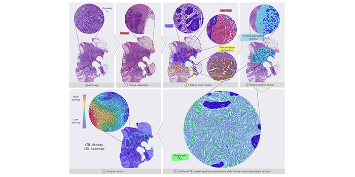 Figure from the article in Cancers, 18 June 2021: Automated Quantification of sTIL Density with H&E-Based Digital Image Analysis Has Prognostic Potential in Triple-Negative Breast Cancers. Figure 1 Overview of the fully automated image analysis pipeline. The input data are the scanned WSI of a TNBC patient, which is then analyzed by multiple steps. First, the tissue (dark red) is recognized from the glass to limit the analysis to only the relevant part of the scanned slide. Secondly, the tissue-level model classifies slide regions into tumor tissue (blue), non-invasive epithelium (yellow), and necrotic regions (red). In the third step, the macro-outline of the tumor is approximated, and then tumor-associated stroma and margin (turquoise) are defined. Cells across the entire sample in the tumor-associated stroma are classified as TILs (green) or not, and finally, the sTIL density and heatmap can be outputted for review.