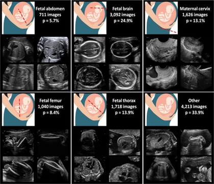 *The image is taken from Burgos-Artizzu, X.P., Coronado-Gutiérrez, D., Valenzuela-Alcaraz, B. et al. Evaluation of deep convolutional neural networks for automatic classification of common maternal fetal ultrasound planes. Sci Rep 10, 10200 (2020).